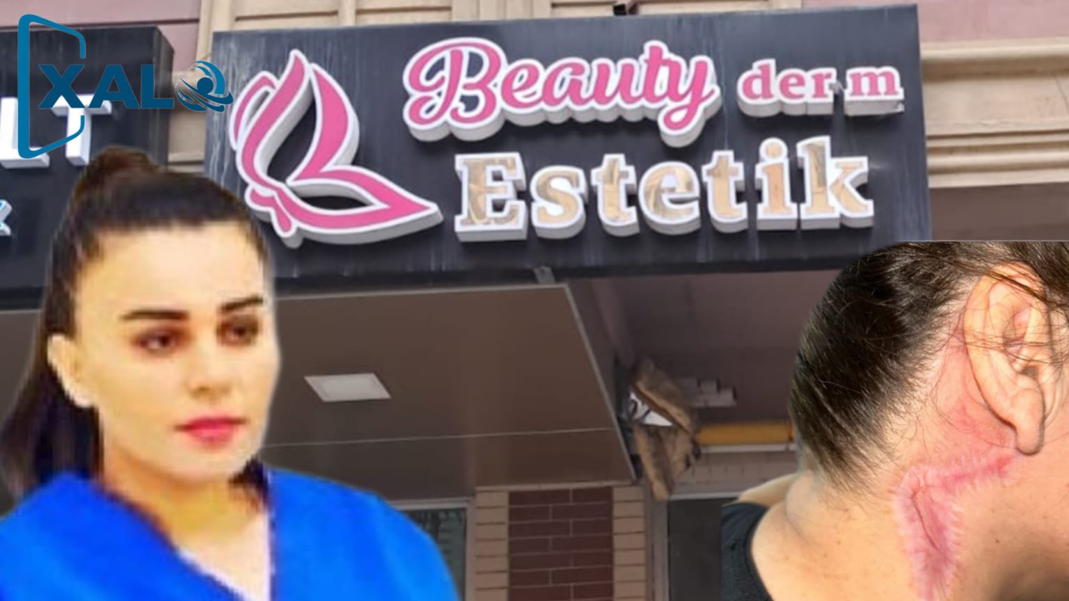 Esmira İbrahimlinin qanunsuz estetik əməliyyatının qurbanı – Şikayətçidir-Foto-Video